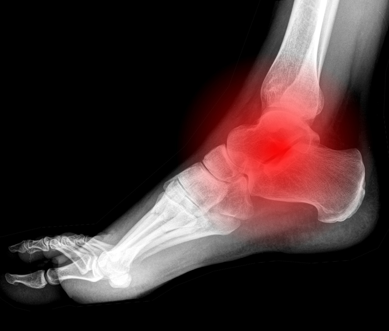 Avoid Foot Injuries